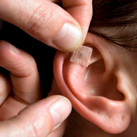 Auriculoterapia